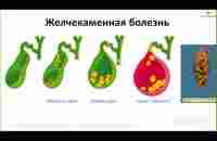 Желчекаменная болезнь - YouTube