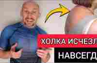 Сделал 1 раз и холка исчезла навсегда и не возвращается - YouTube